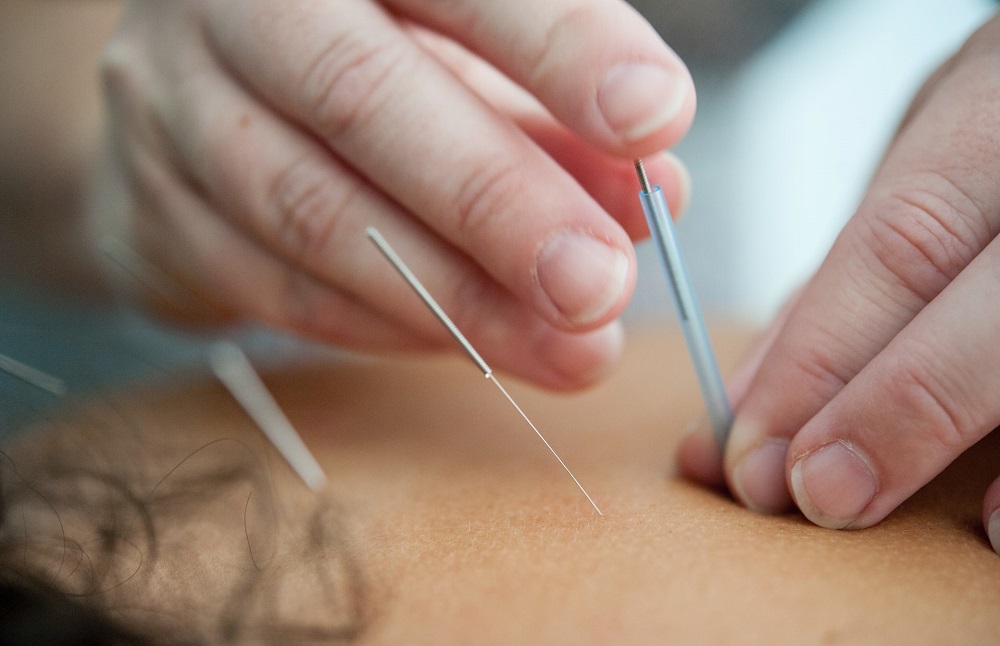 Dry Needling Denver, CO 